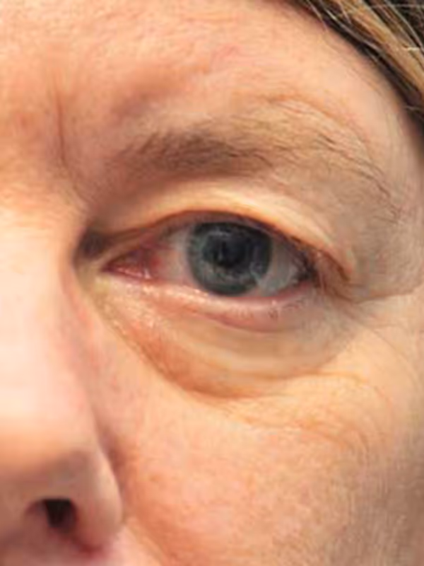 Eyelidlift10