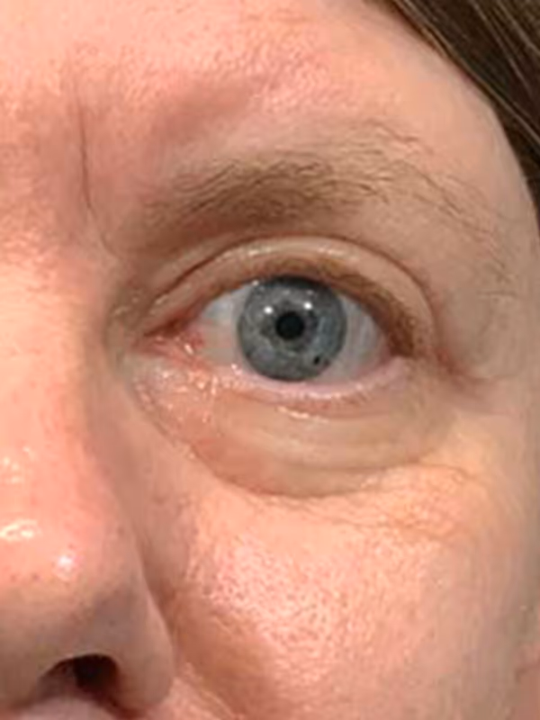 Eyelidlift10