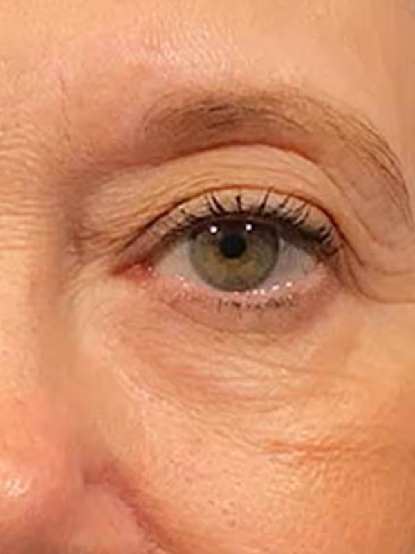 Eyelidlift11