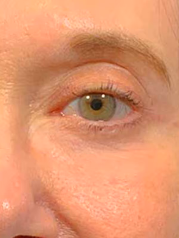 Eyelidlift11