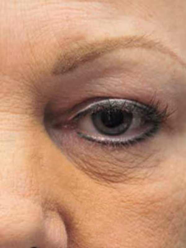 Eyelidlift12