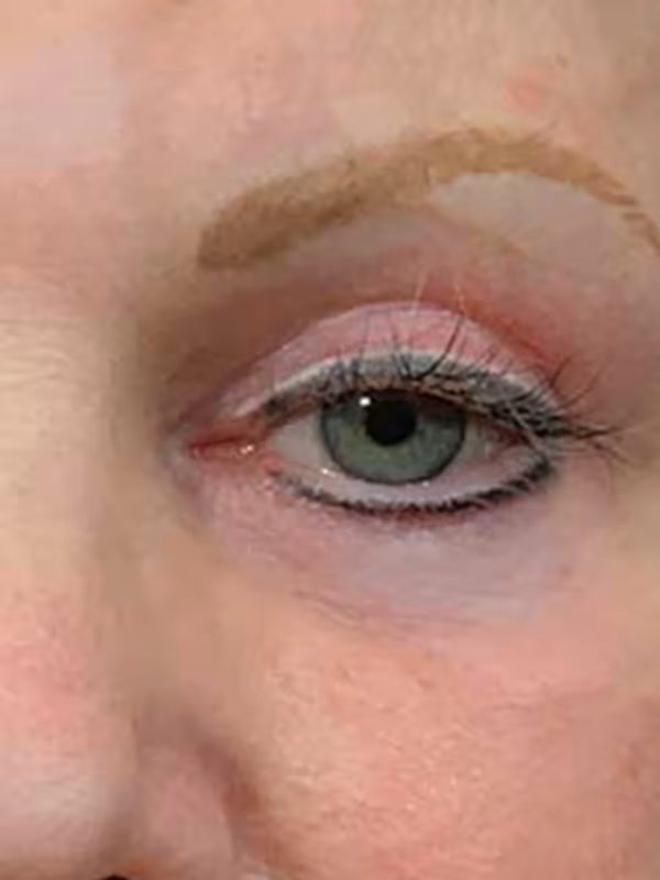 Eyelidlift12