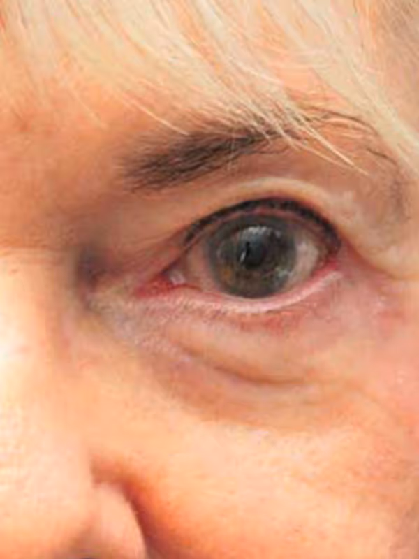 Eyelidlift13