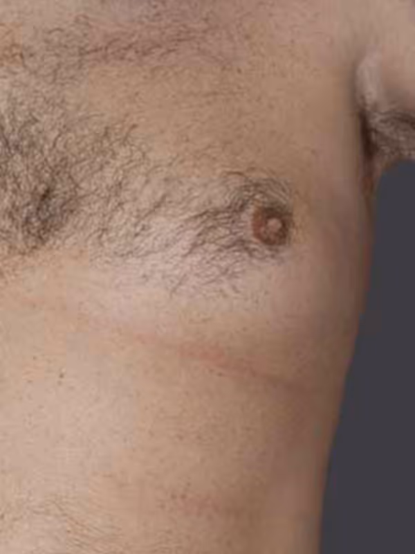 MaleBreastReduction1