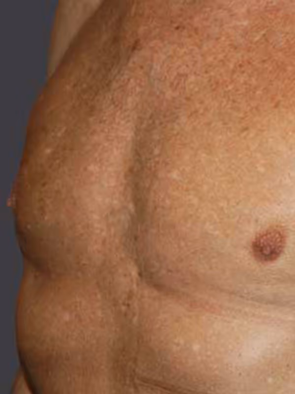 MaleBresatReduction3