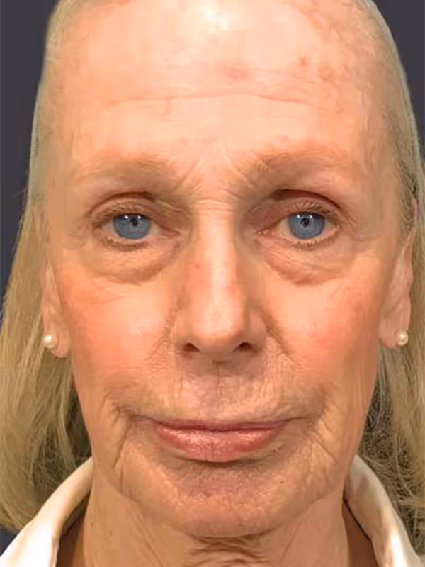 Facial Fat Transfer1