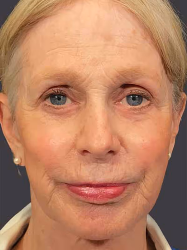 Facial Fat Transfer1