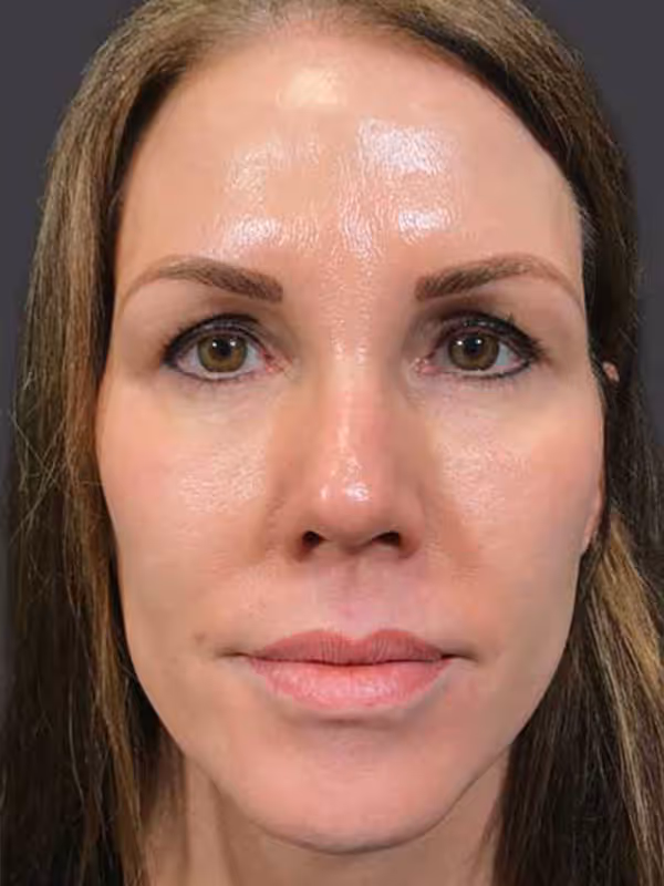 Facial Fat Transfer2