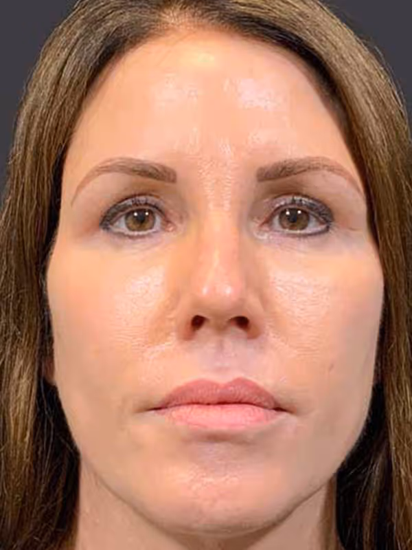 Facial Fat Transfer2