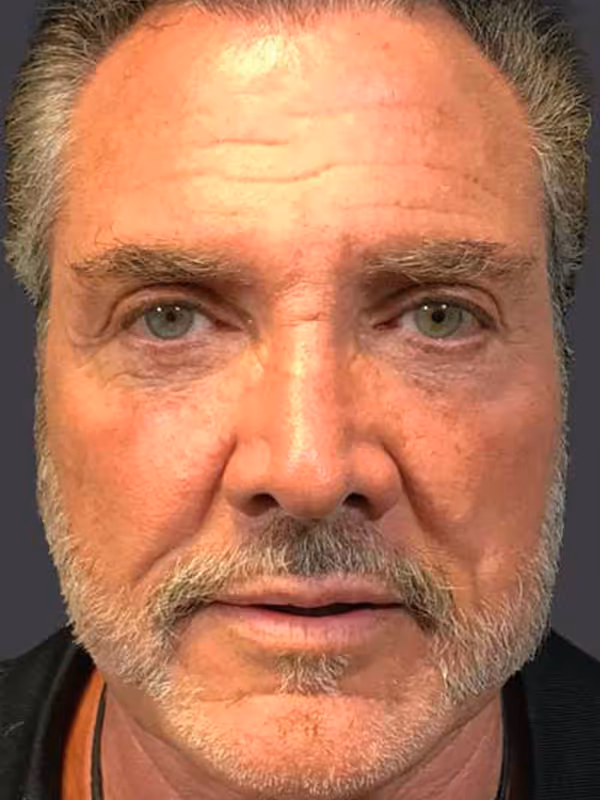 Facial Fat Transfer3