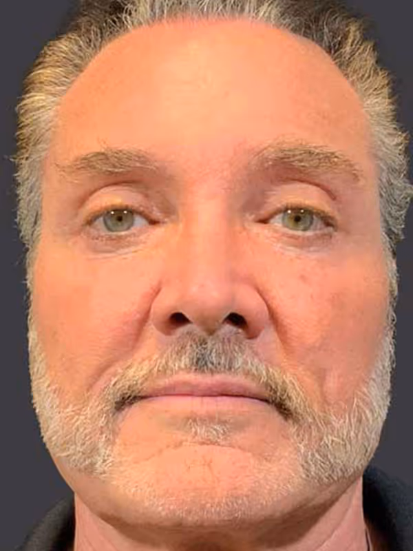 Facial Fat Transfer3