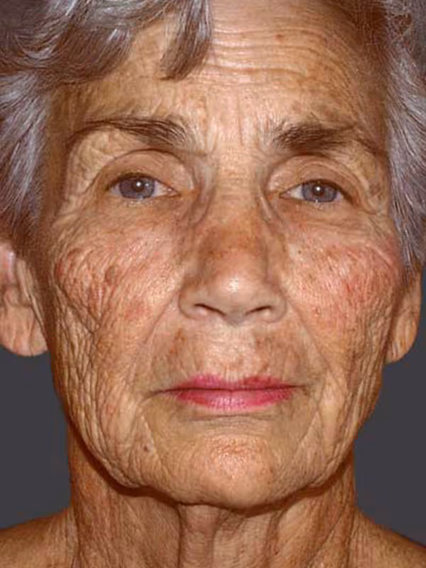 Facial Fat Transfer4