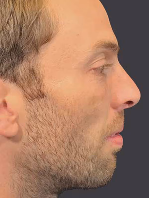Chin Implant1