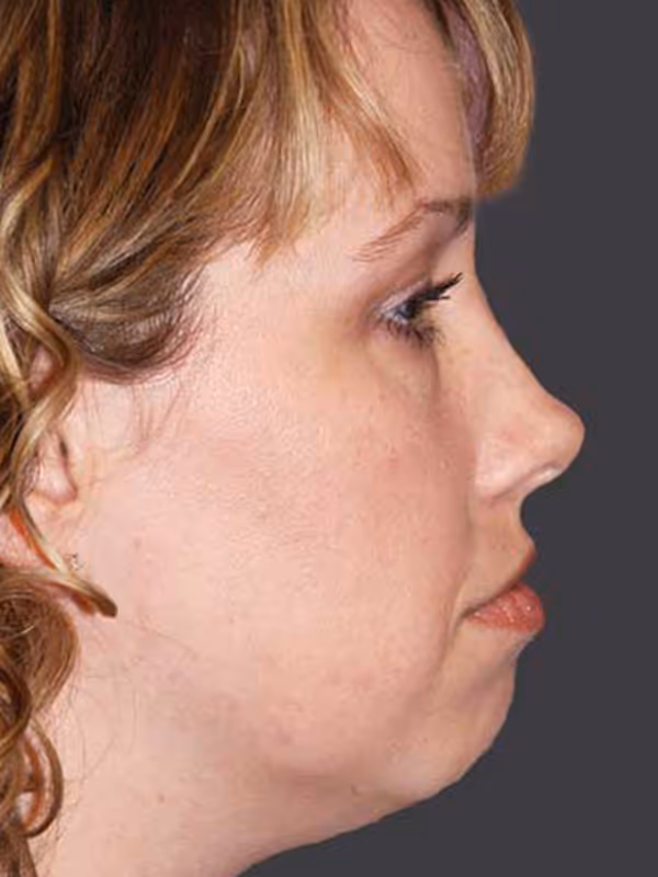 Chin Implant2