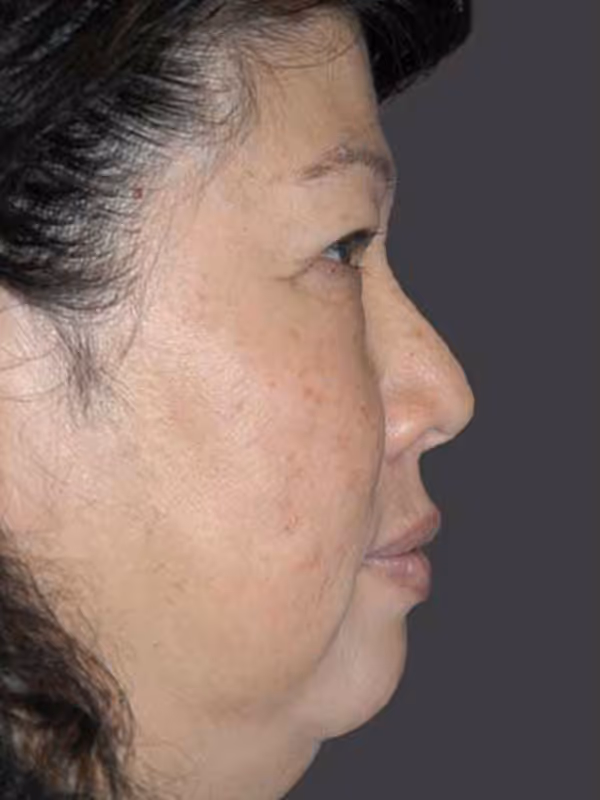 Chin Implant3