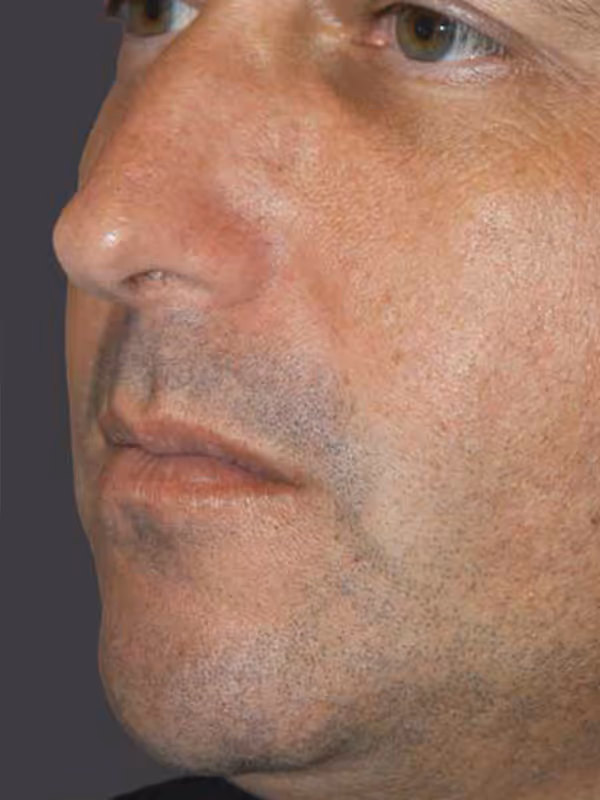 Chin Implant4