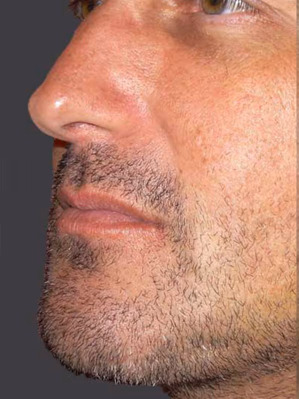 Chin Implant4