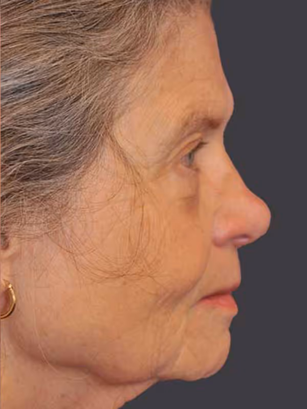 Chin Implant6