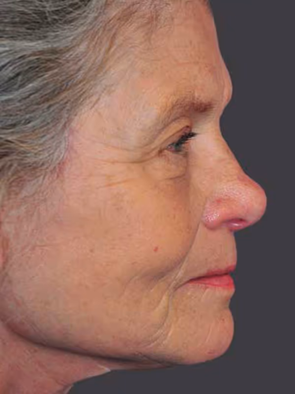 Chin Implant6