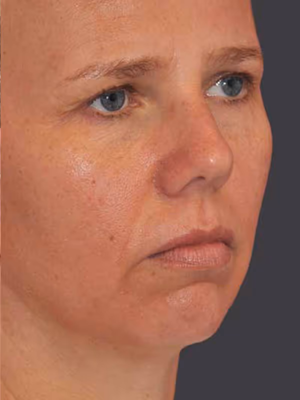 Chin Implant8