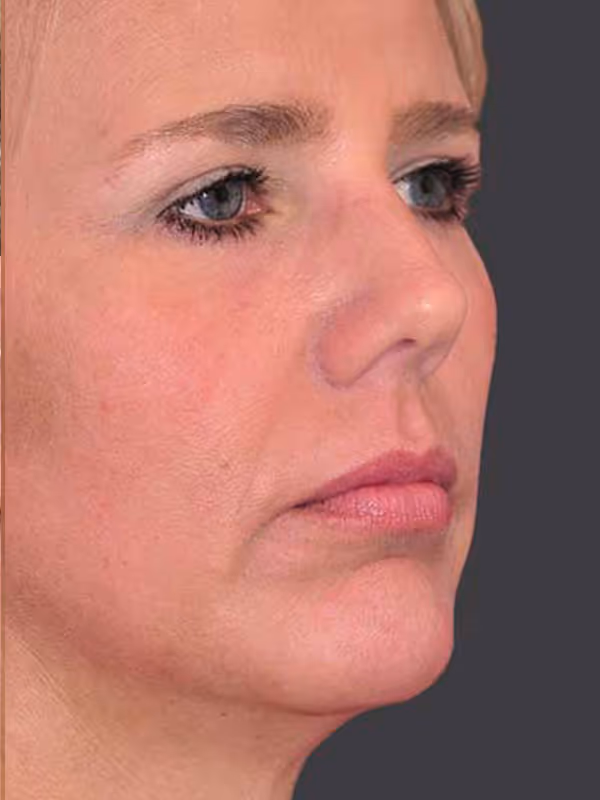 Chin Implant8
