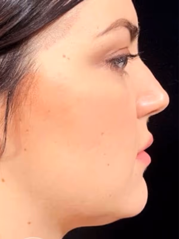 DRRICE_SUBMENTALLIPO