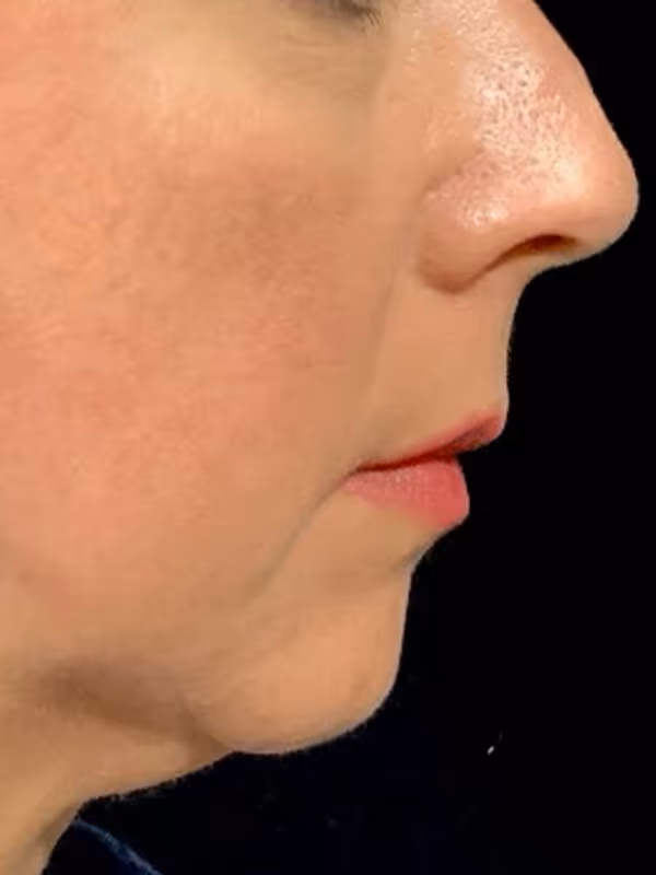 BRENNA_LIQUID_FACELIFT