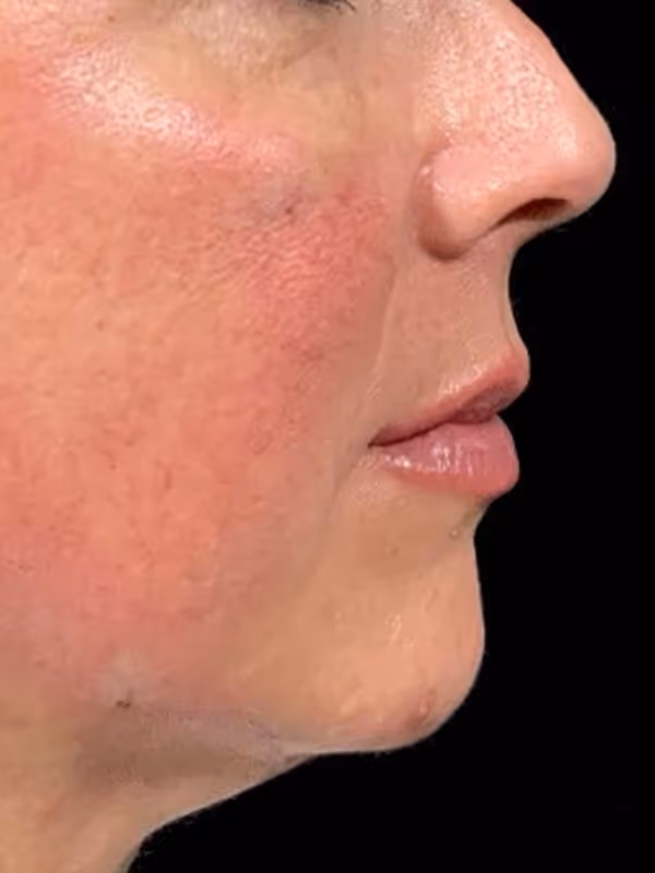 BRENNA_LIQUID_FACELIFT