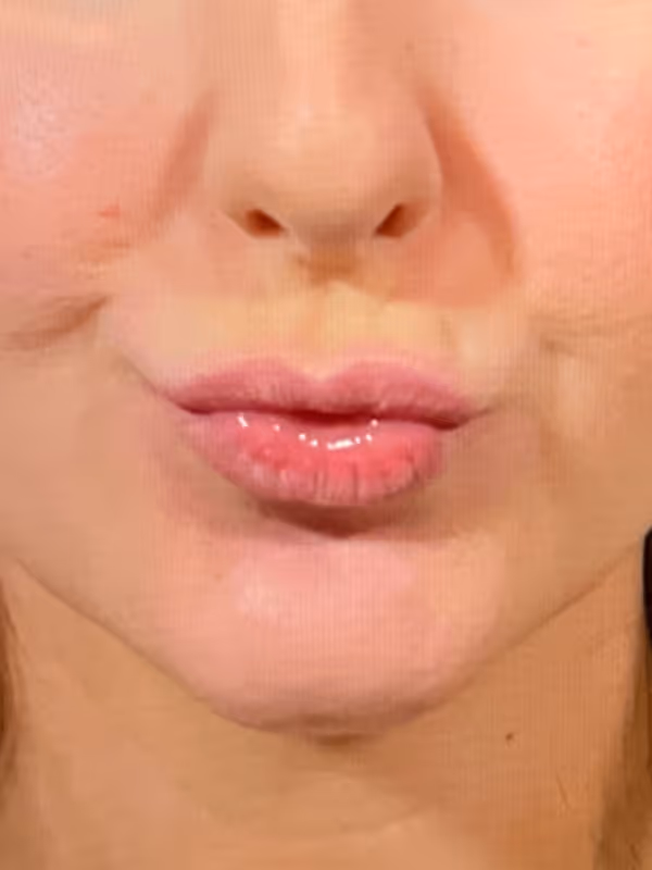 STEPHANIE_LIPFILLER_ULTRA