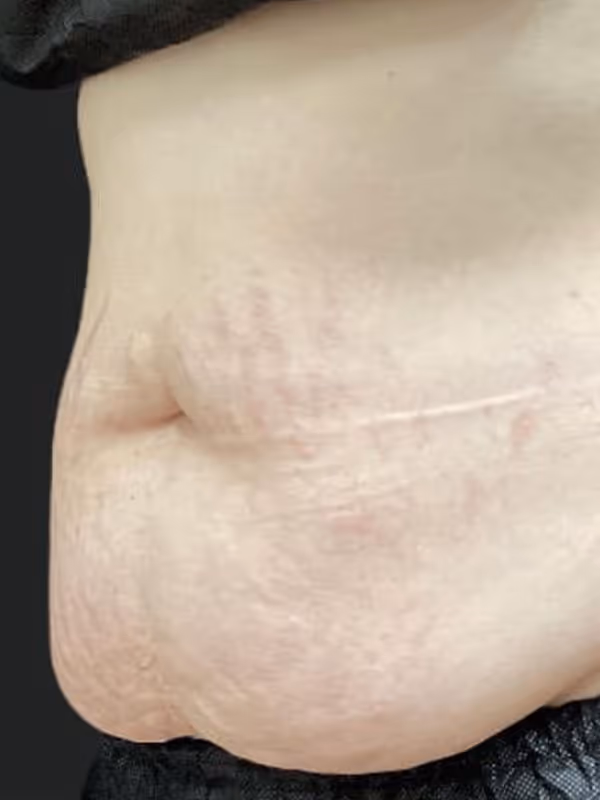 JOHANNA_COOLSCULPTING