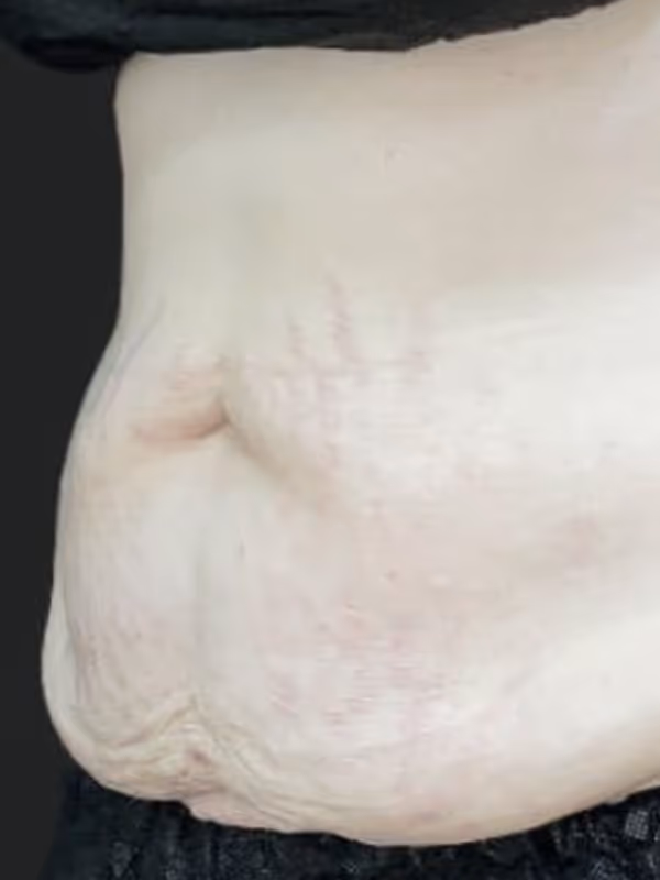 JOHANNA_COOLSCULPTING