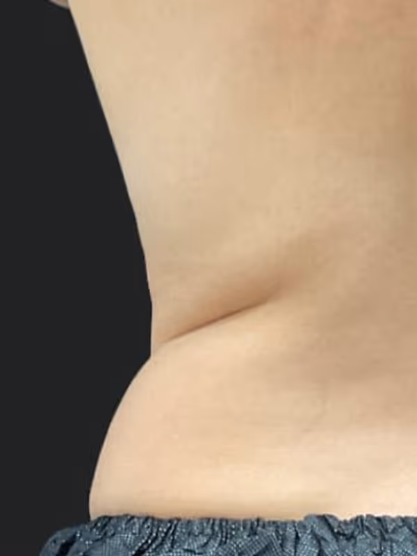 JOHANNA_COOLSCULPTING