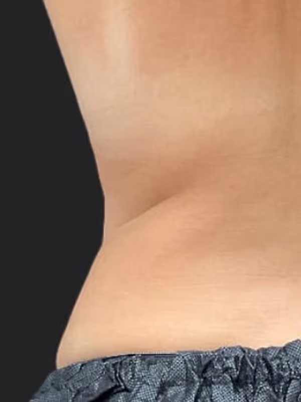 JOHANNA_COOLSCULPTING
