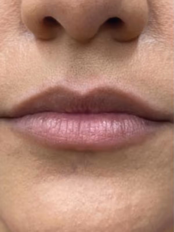 JOCELYN_LIP_FILLER