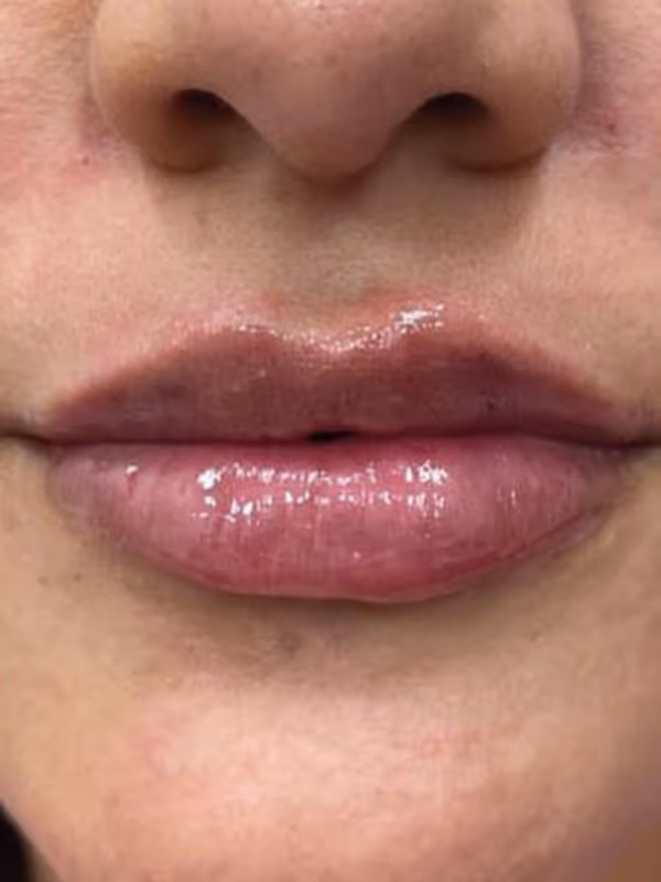 JOCELYN_LIP_FILLER
