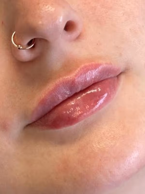 LAURENB_LIP_FILLER