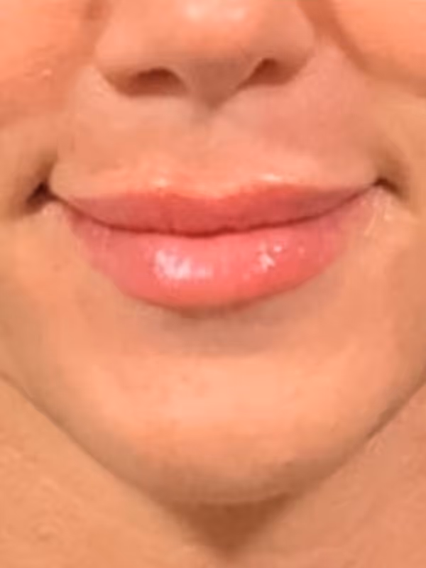 LAURENB_LIP_FILLER