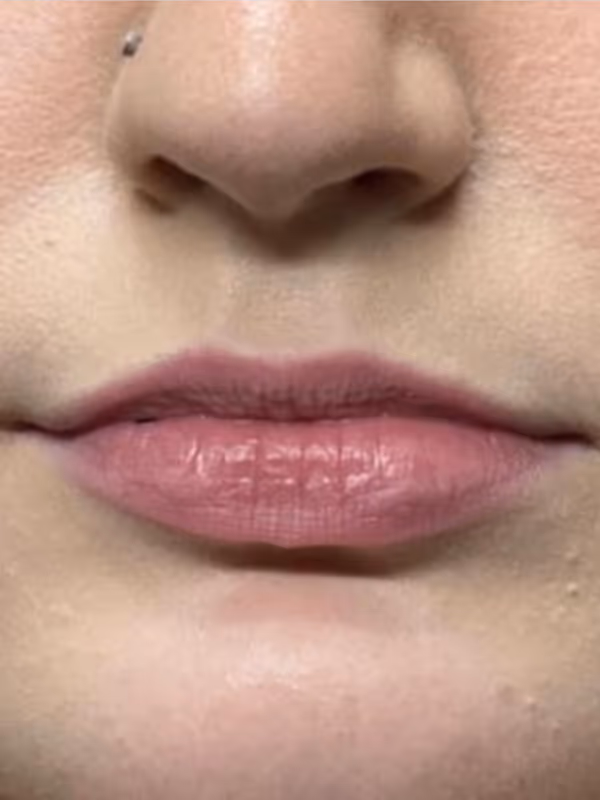 SIERRA_LIP_FILLER