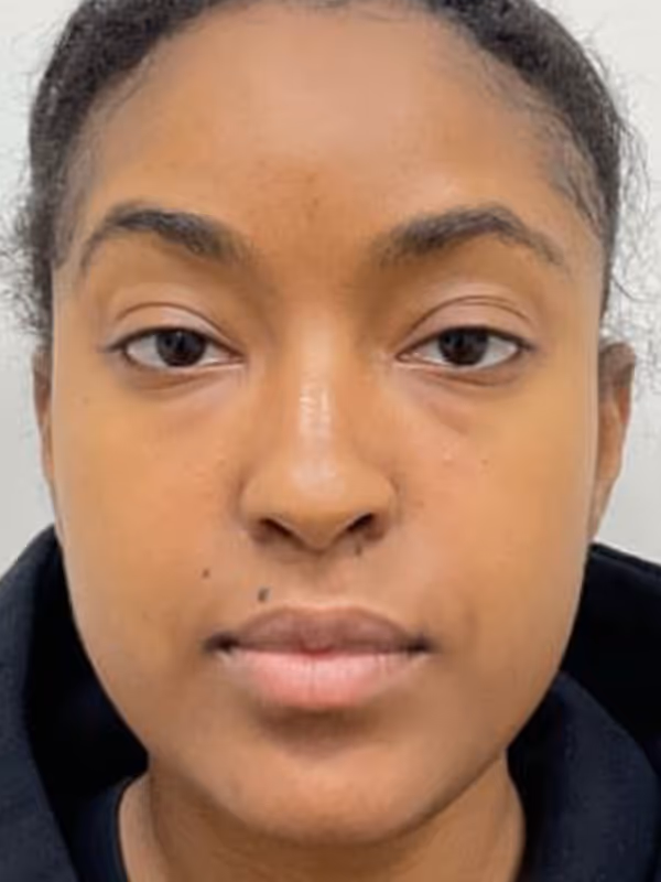 LAURENS_FILLER_BOTOX