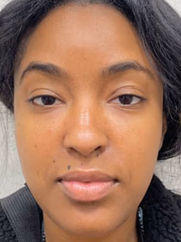 LAURENS_FILLER_BOTOX