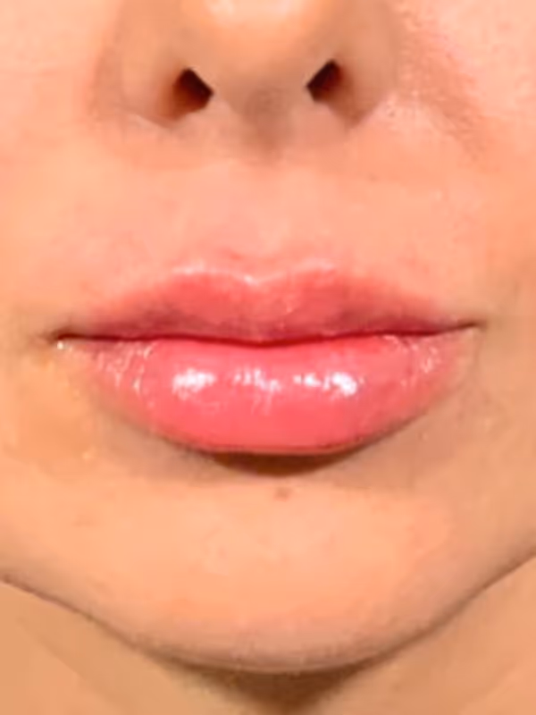 MELISSA_LIP_FILLER