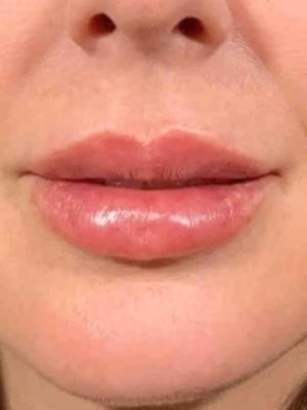 BRENNA_LIP_FILLER