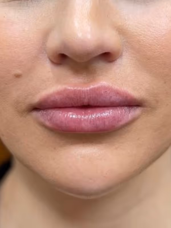 BRENNA_LIP_FILLER