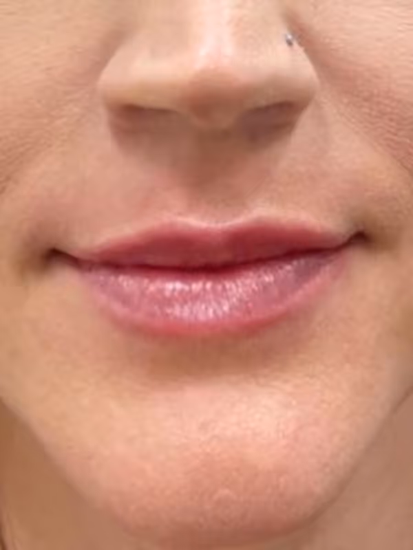 BRENNA_LIP_FILLER
