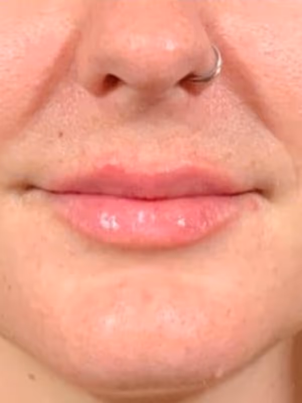JOANNA_LIP_FILLER