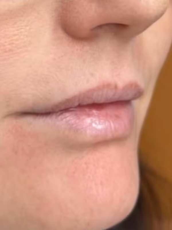 JAMIE_LIP_FILLER