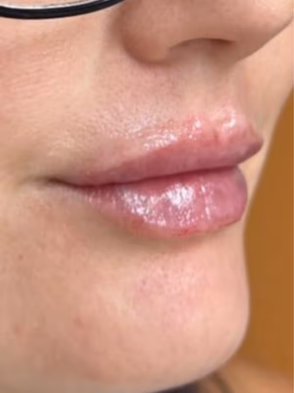 JAMIE_LIP_FILLER