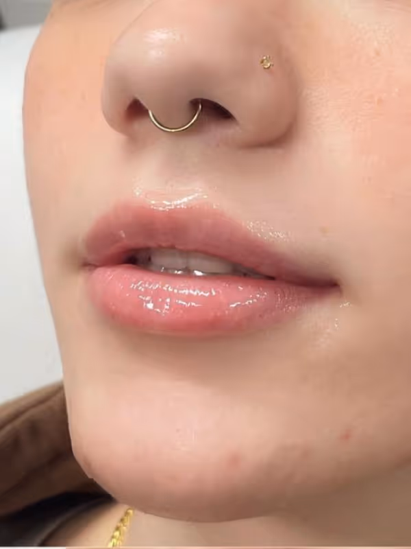 JAMIE_LIP_FILLER