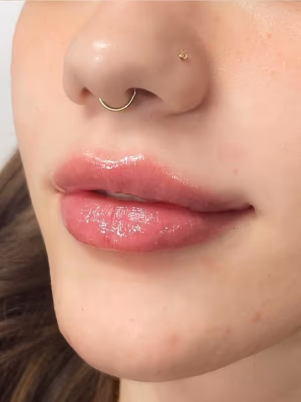 JAMIE_LIP_FILLER