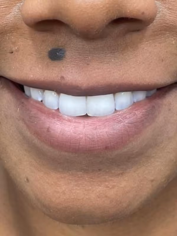 JOCELYN_LIP_FILLER